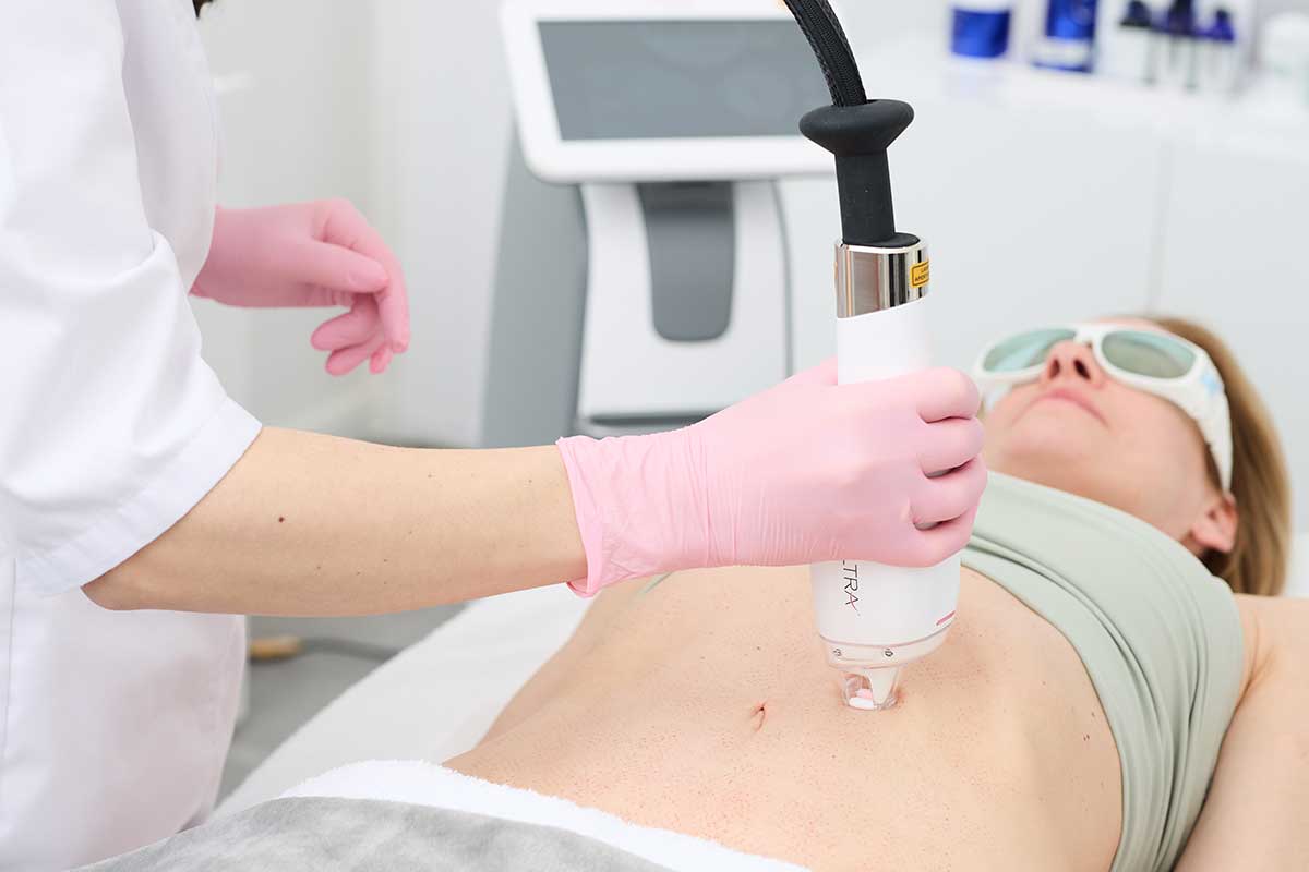 LaseMD Ultra Bauchbereich Behandlung bei My Perfect Face Berlin-Mitte